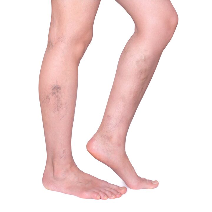Indications for the primation of ZXCVBNQWERT - Nabushhiy, convincing veins on the legs