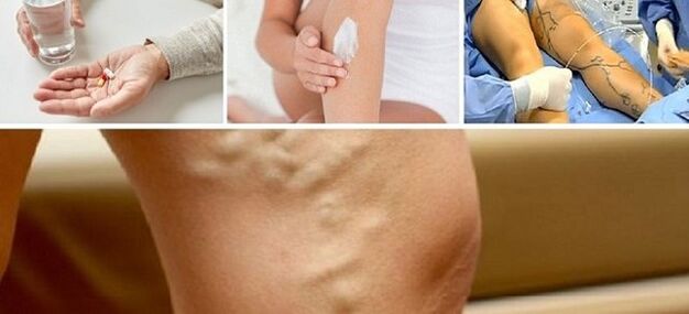Treatment of varicose veins
