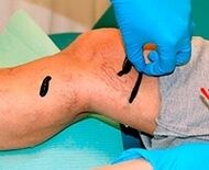Leeches for varicose veins