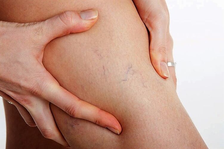 Varicose grill on the leg