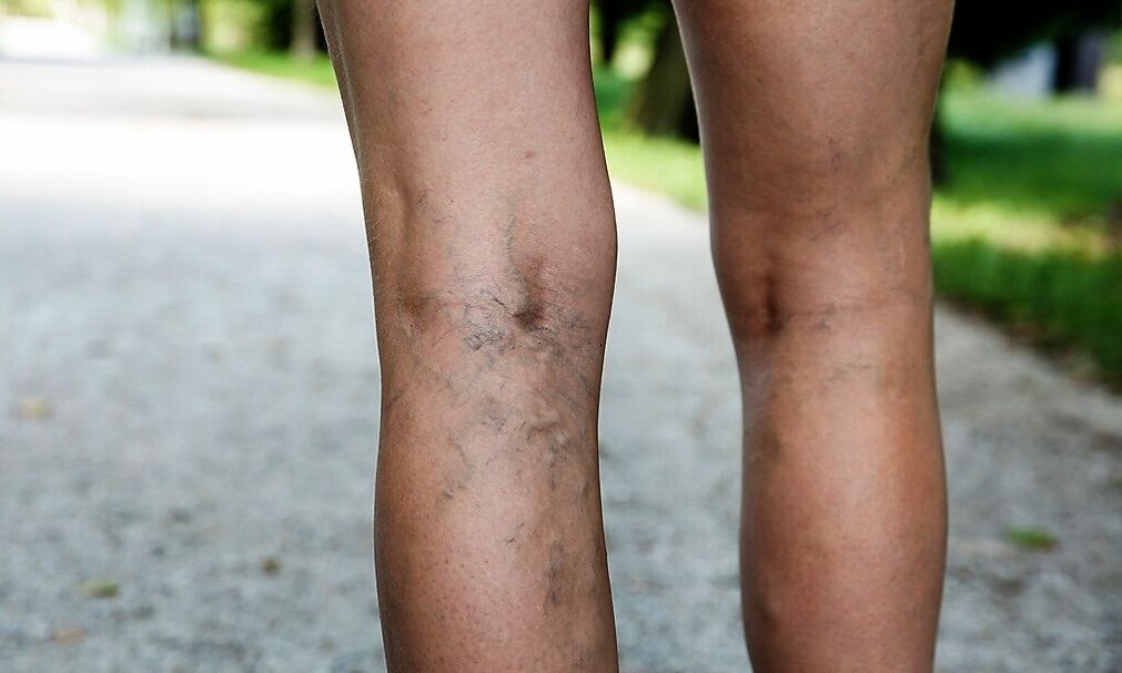 Veins expanded on the legs