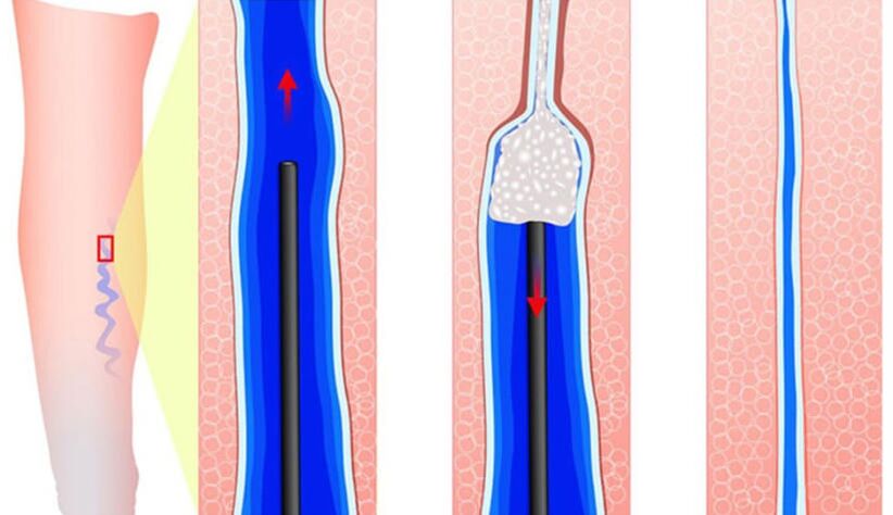 Introduction of sclerosante to sclerotherapy