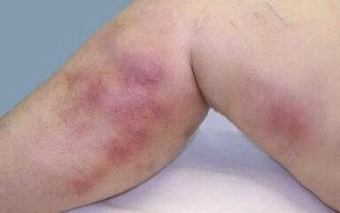 How varicose veins are manifested