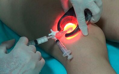 sclerotherapy as a way of treating varicose veins on the legs