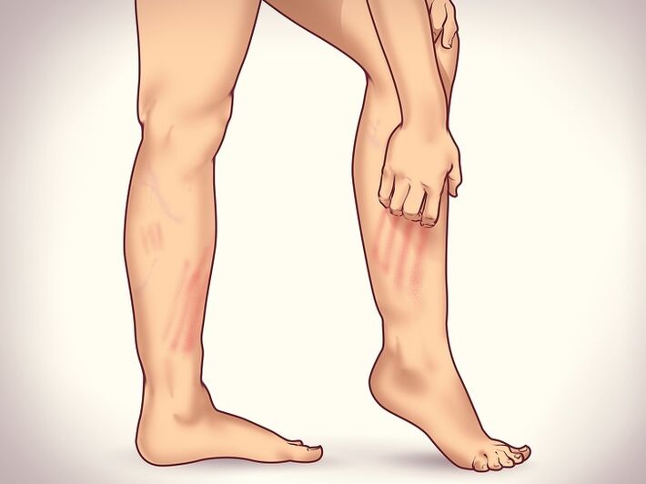 6 not obvious signs of varicose veins