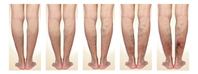 Phase of varicose veins