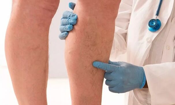 The phlebologist examines the patient