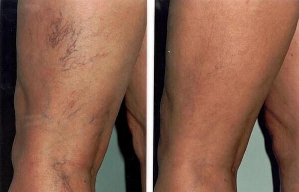 photos before and after treatment of varicose veins
